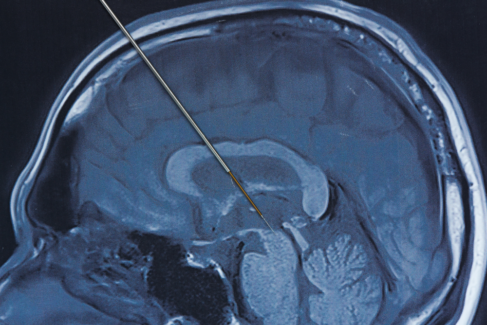 Lucendra Consulting Active Implantable Medical Devices